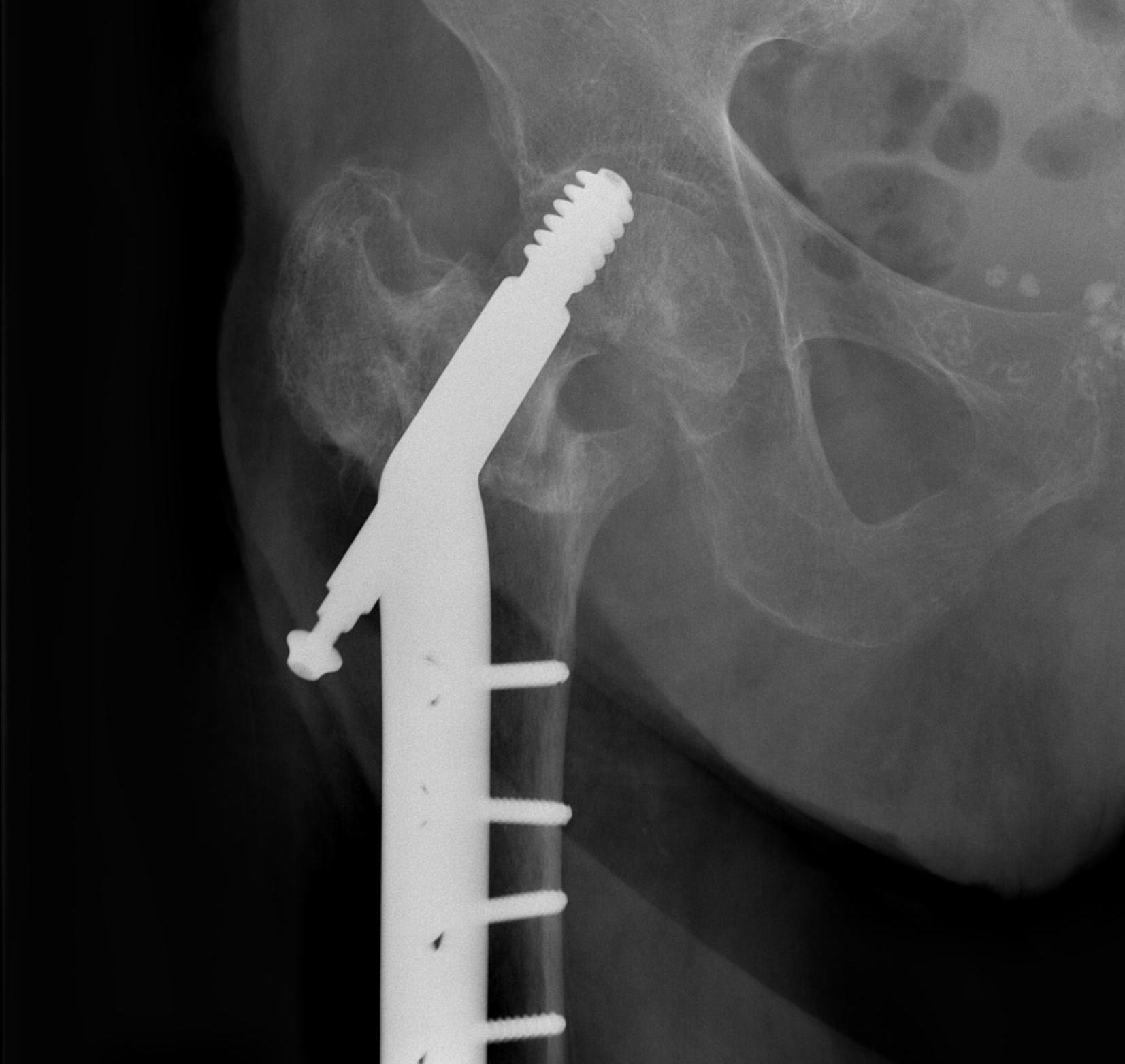 Intertrochanteric Fractures The Bone School